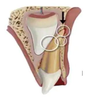 Chấn thương răng sữa có thể gây ảnh hưởng  mầm răng vĩnh viễn bên dưới